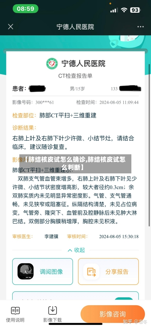 【肺结核皮试怎么确诊,肺结核皮试怎么判断】-第2张图片