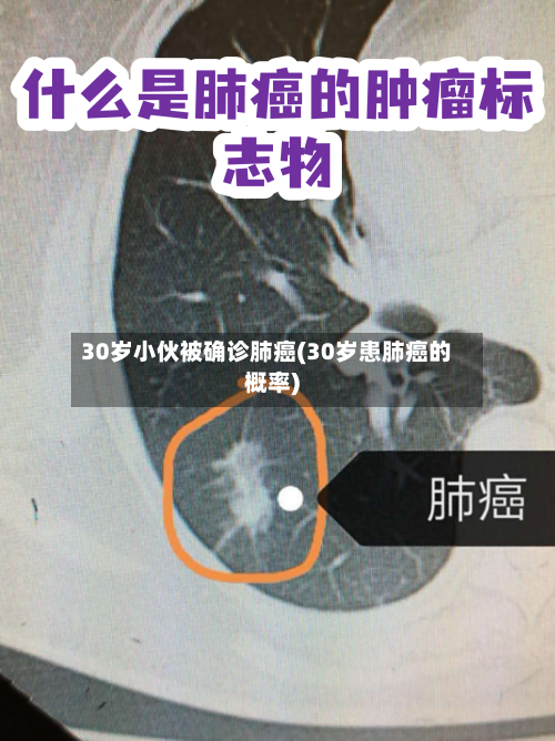 30岁小伙被确诊肺癌(30岁患肺癌的概率)