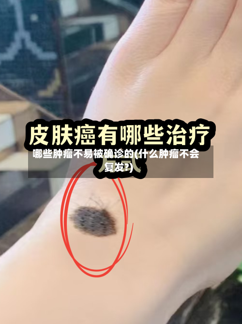 哪些肿瘤不易被确诊的(什么肿瘤不会复发?)