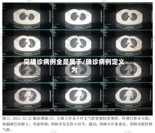 突确诊病例全是属于/确诊病例定义为-第2张图片