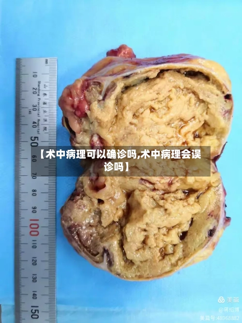 【术中病理可以确诊吗,术中病理会误诊吗】
