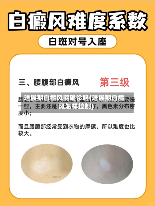 进展期白癜风能确诊吗(进展期白癜风怎样控制)