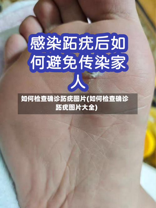 如何检查确诊跖疣图片(如何检查确诊跖疣图片大全)-第2张图片