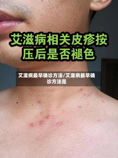 艾滋病最早确诊方法/艾滋病最早确诊方法是