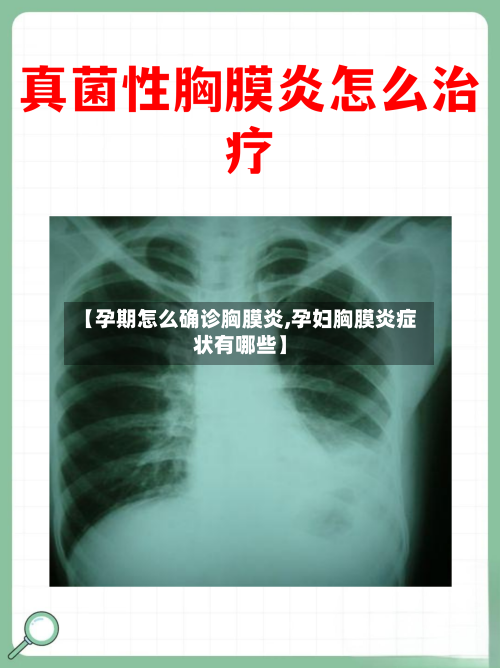 【孕期怎么确诊胸膜炎,孕妇胸膜炎症状有哪些】-第3张图片