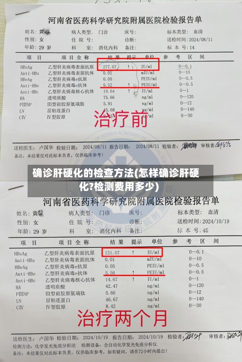 确诊肝硬化的检查方法(怎样确诊肝硬化?检测费用多少)