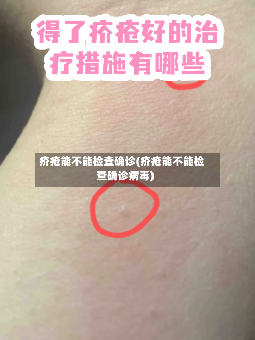 疥疮能不能检查确诊(疥疮能不能检查确诊病毒)